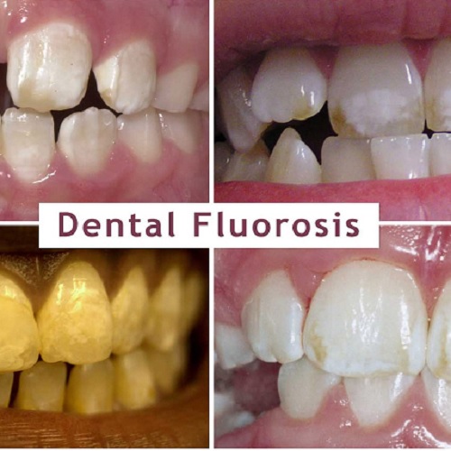 فلوراید زیاد موجب تغییر رنگ دندان ها میشود